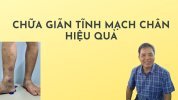 chua-gian-tinh-mach-chan-hieu-qua.jpg