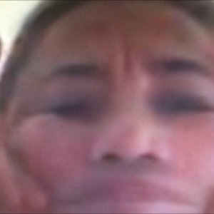 Clip 5 Uống đường tự chữa khỏi bệnh méo miệng liệt mặt